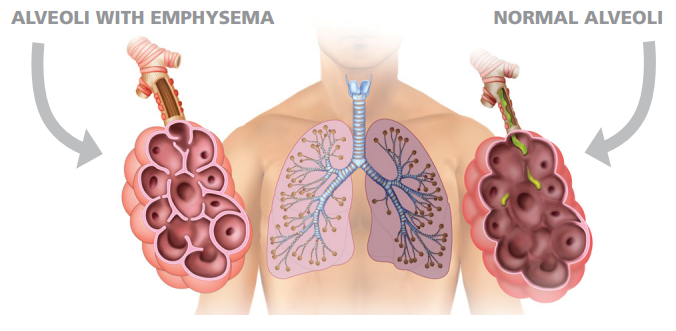 Normal alveoli  and alveoli with emphysema