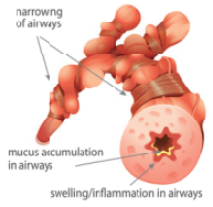 Diagram of COPD flare