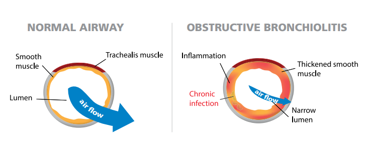 Diagram of a normal airway and one affected by bronchiolitis