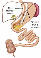 Sleeve Gastrectomy procedure