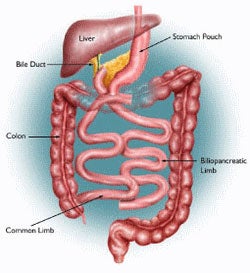 Laparoscopic-BPD