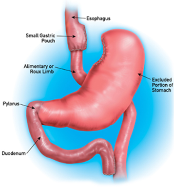 Gastric Bypass