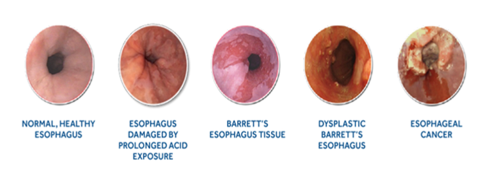 esophagus gallery